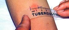 Tuberkuloos Tuberkuloos