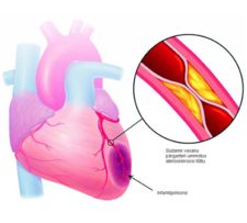 Südamelihase infarkt Südamelihase infarkt