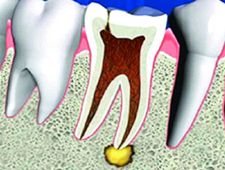 Hamba juuretipupõletik