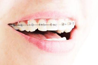 Ortodont vastab: kas pärast breketite eemaldamist nihkuvad hambad tagasi?
