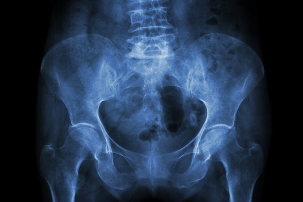 Eakaid inimesi kimbutab üha enam osteoporoos