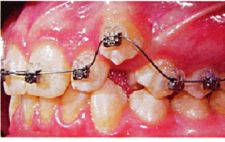 Ortodontiline ravi