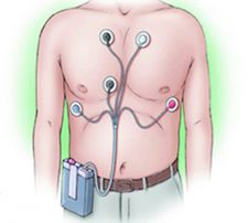 Holter-monitooring